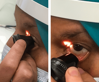 Glaucoma 2