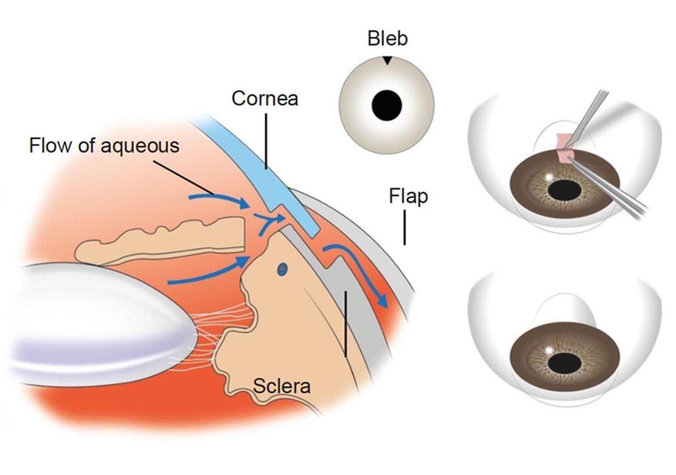 Glaucoma 3