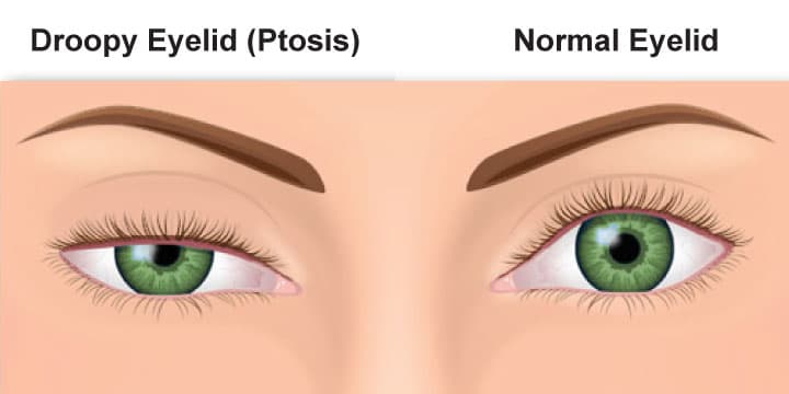 Orbit and Oculoplasty 2