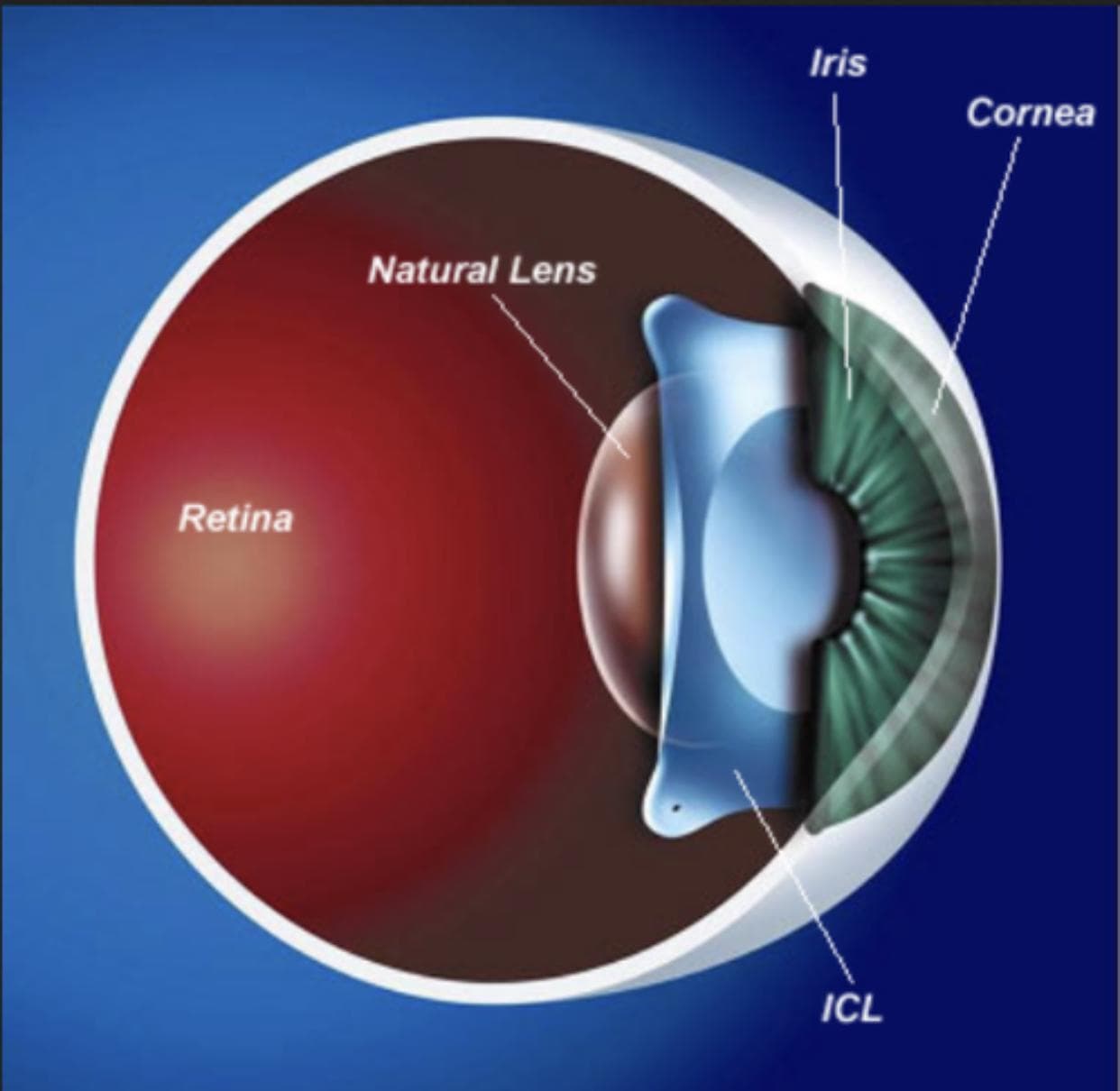 Refractive Correction 3