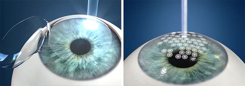 Refractive Correction 1