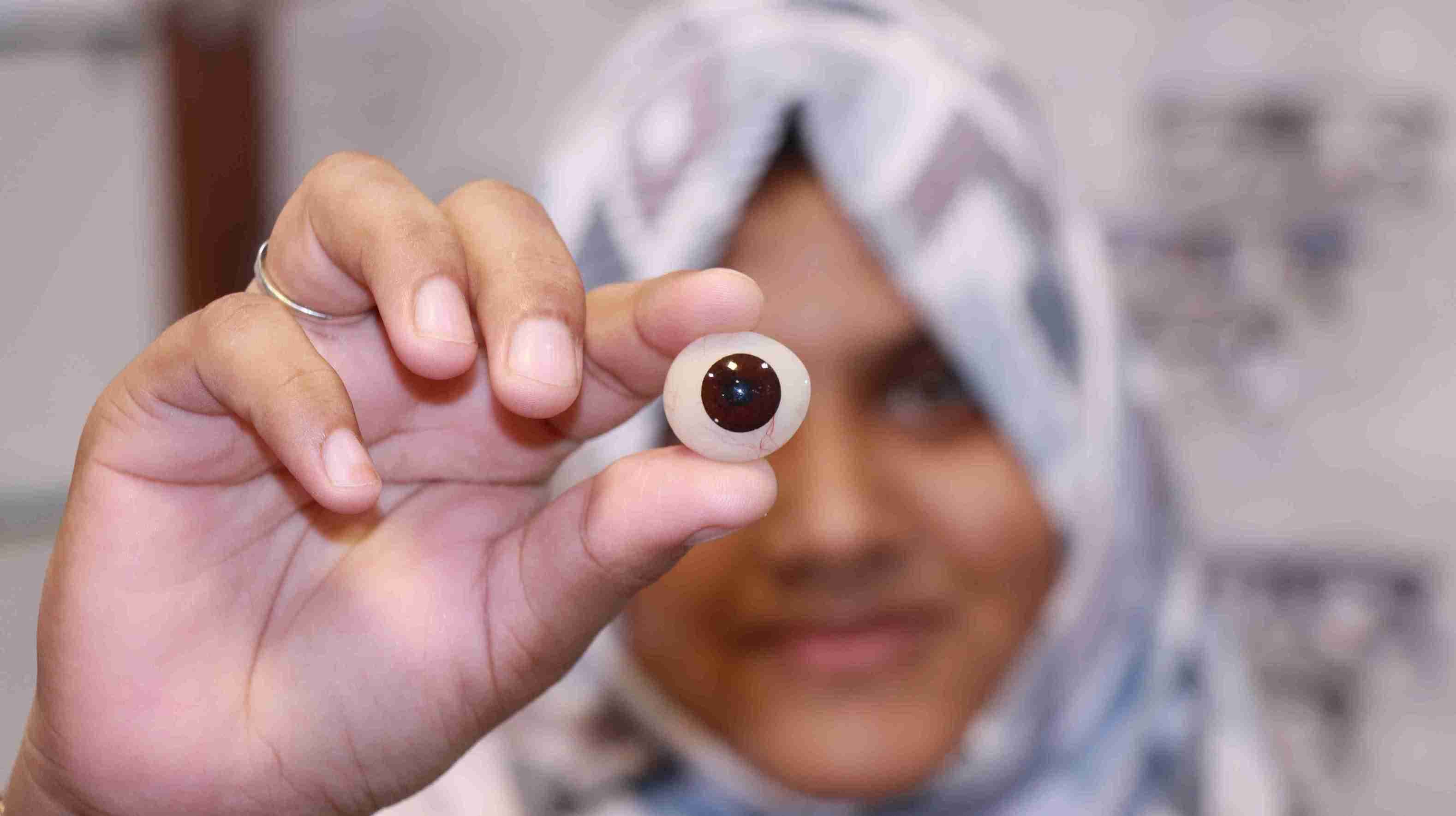 Prosthetic Eye