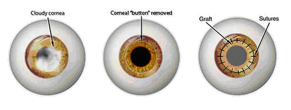 Cornea 2