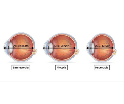 Myopia Screening 2